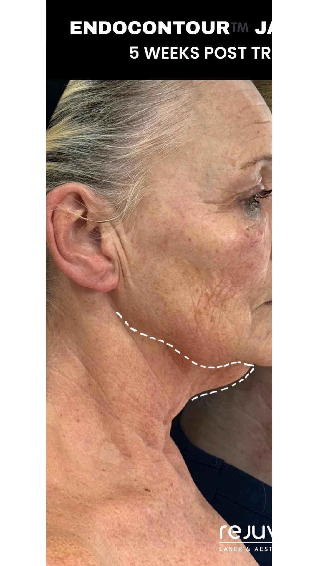 EndoContour before — Rejuvena Clinic Bedford