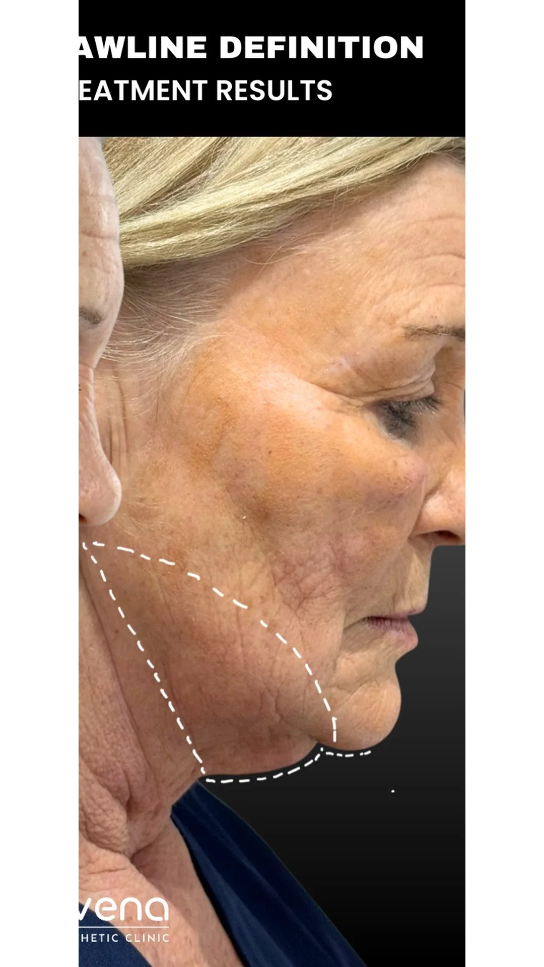 EndoContour after — Rejuvena Clinic Bedford