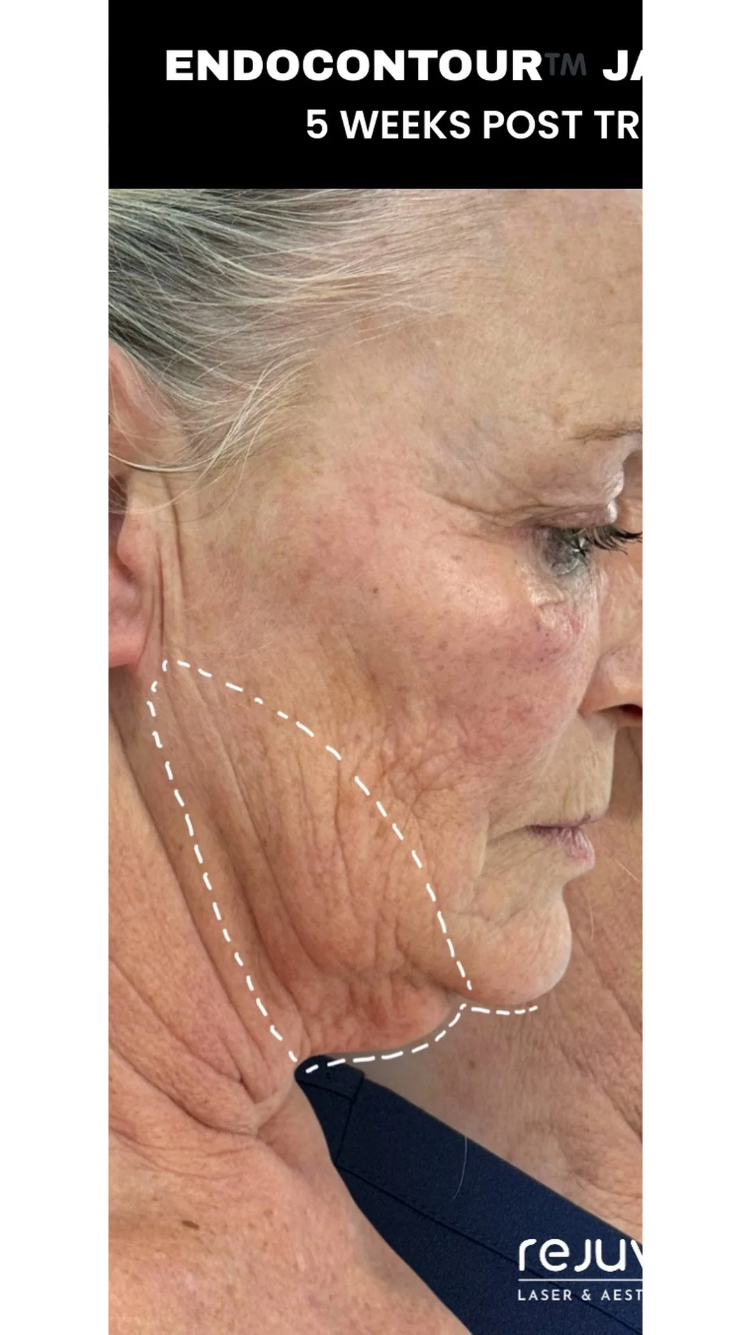 EndoContour before — Rejuvena Clinic Bedford