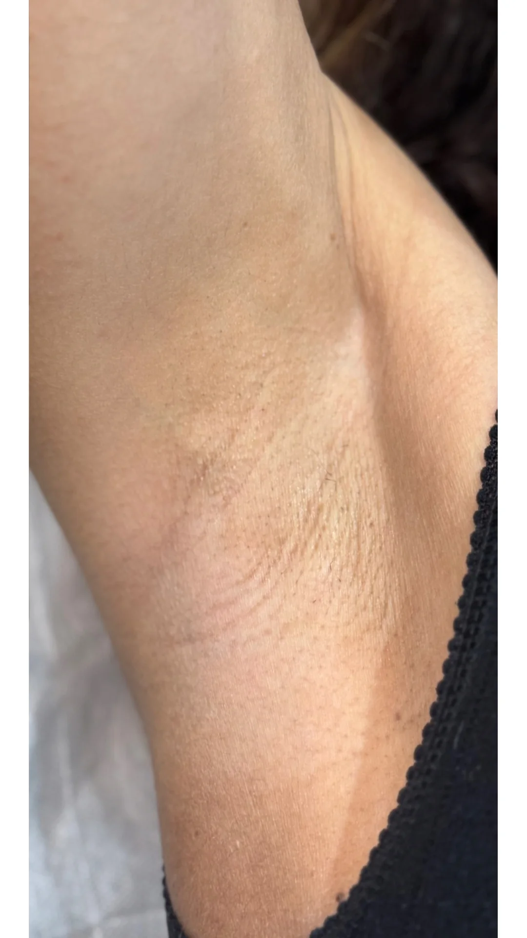 Laser Hair Removal after — Rejuvena Clinic Bedford