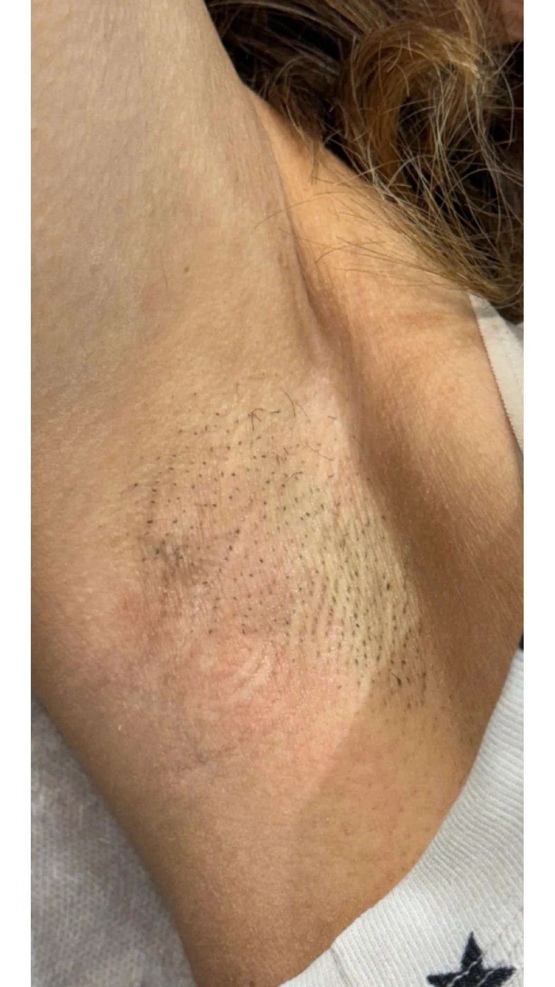 Laser Hair Removal before — Rejuvena Clinic Bedford