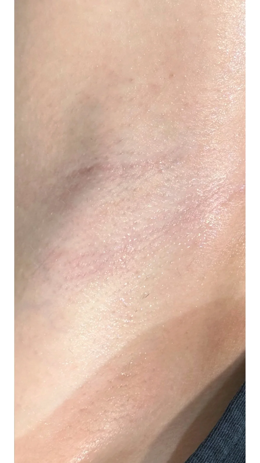 Laser Hair Removal after — Rejuvena Clinic Bedford