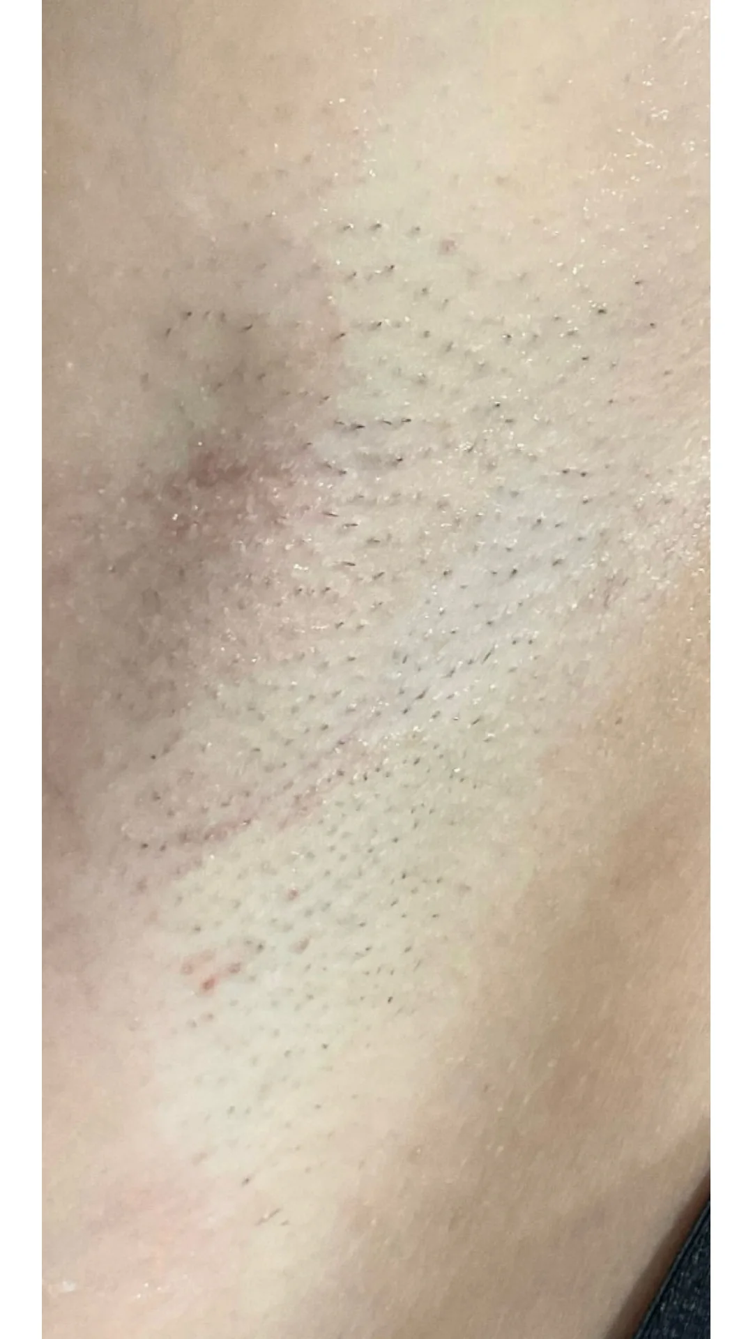 Laser Hair Removal before — Rejuvena Clinic Bedford