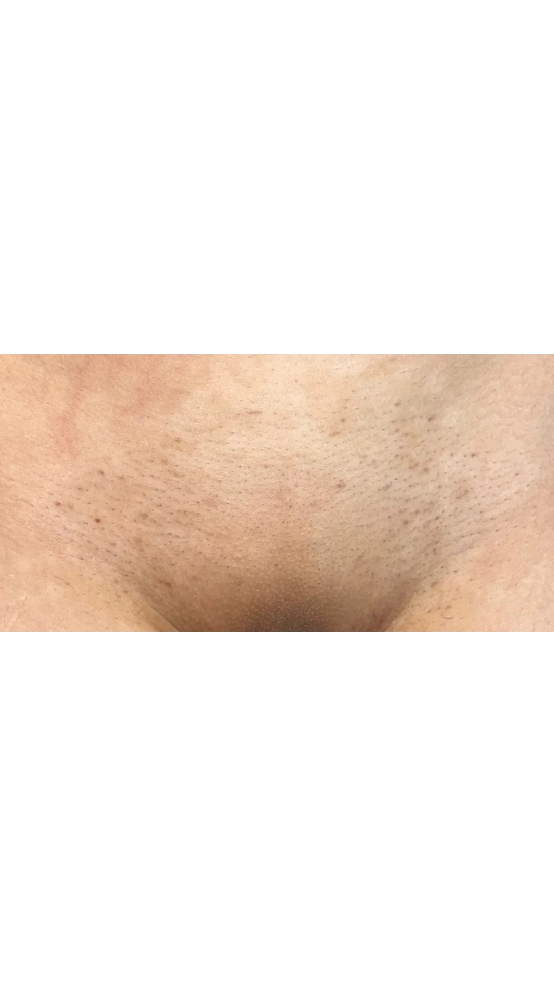 Laser Hair Removal after — Rejuvena Clinic Bedford