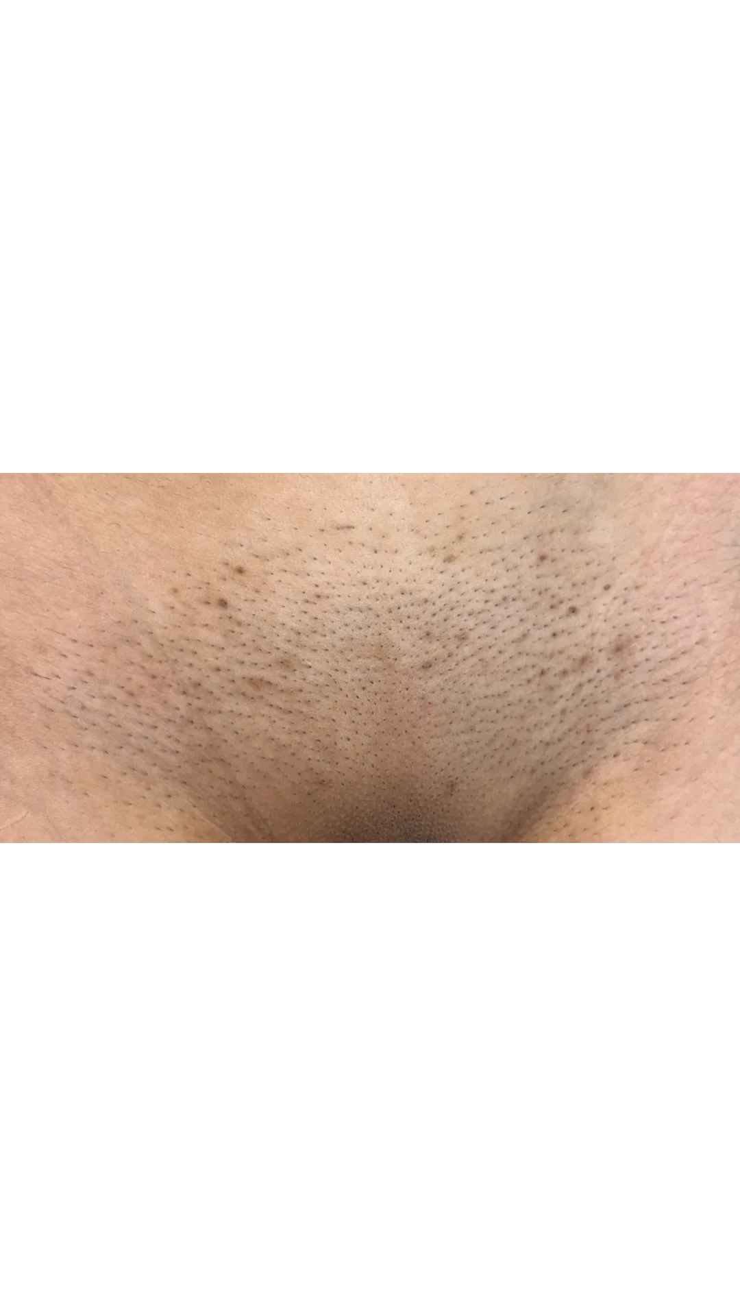 Laser Hair Removal before — Rejuvena Clinic Bedford