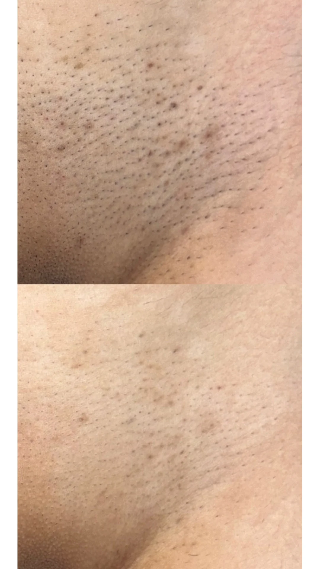 Laser Hair Removal after — Rejuvena Clinic Bedford