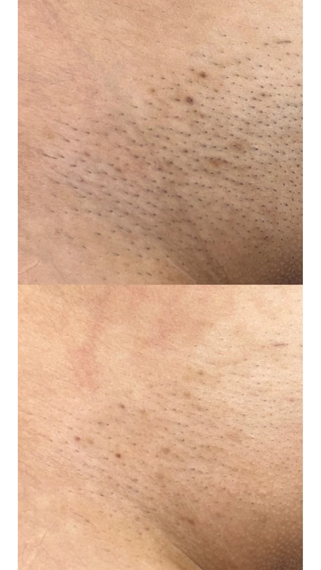 Laser Hair Removal before — Rejuvena Clinic Bedford
