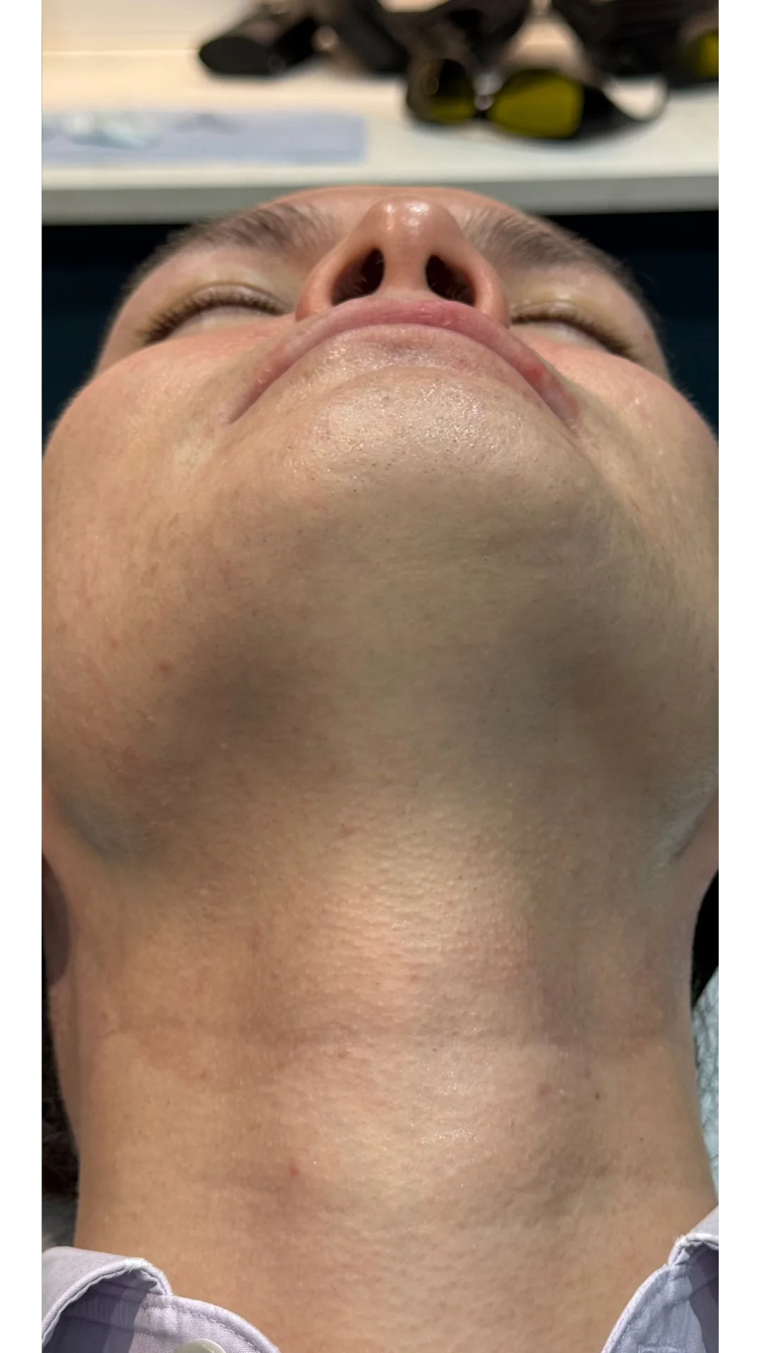 Laser Hair Removal after — Rejuvena Clinic Bedford