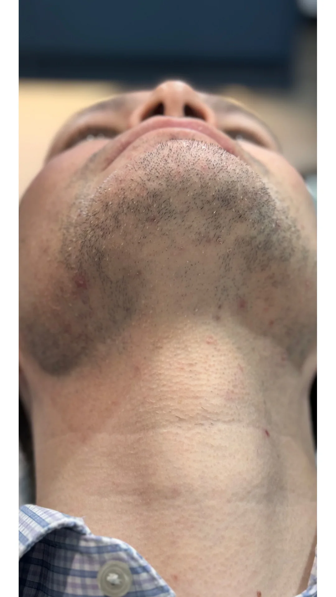 Laser Hair Removal before — Rejuvena Clinic Bedford