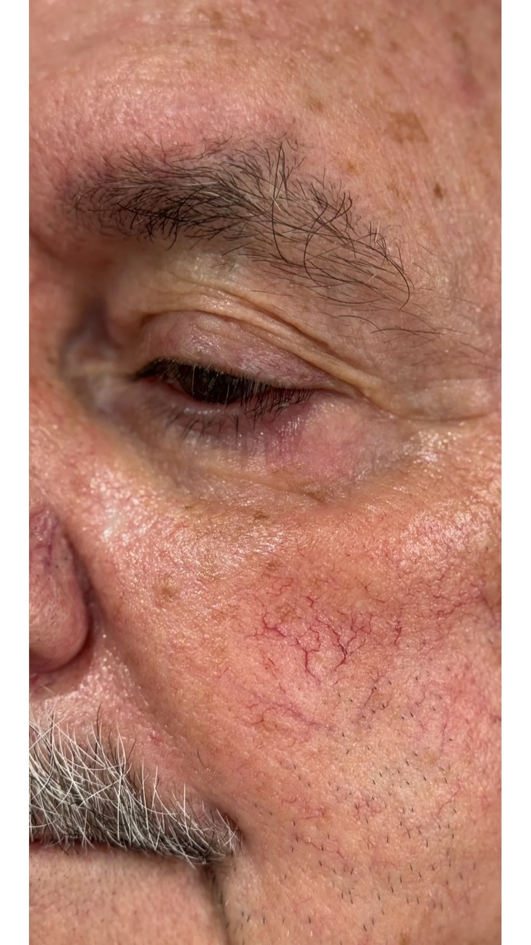Lesions & Moles Removal after — Rejuvena Clinic Bedford