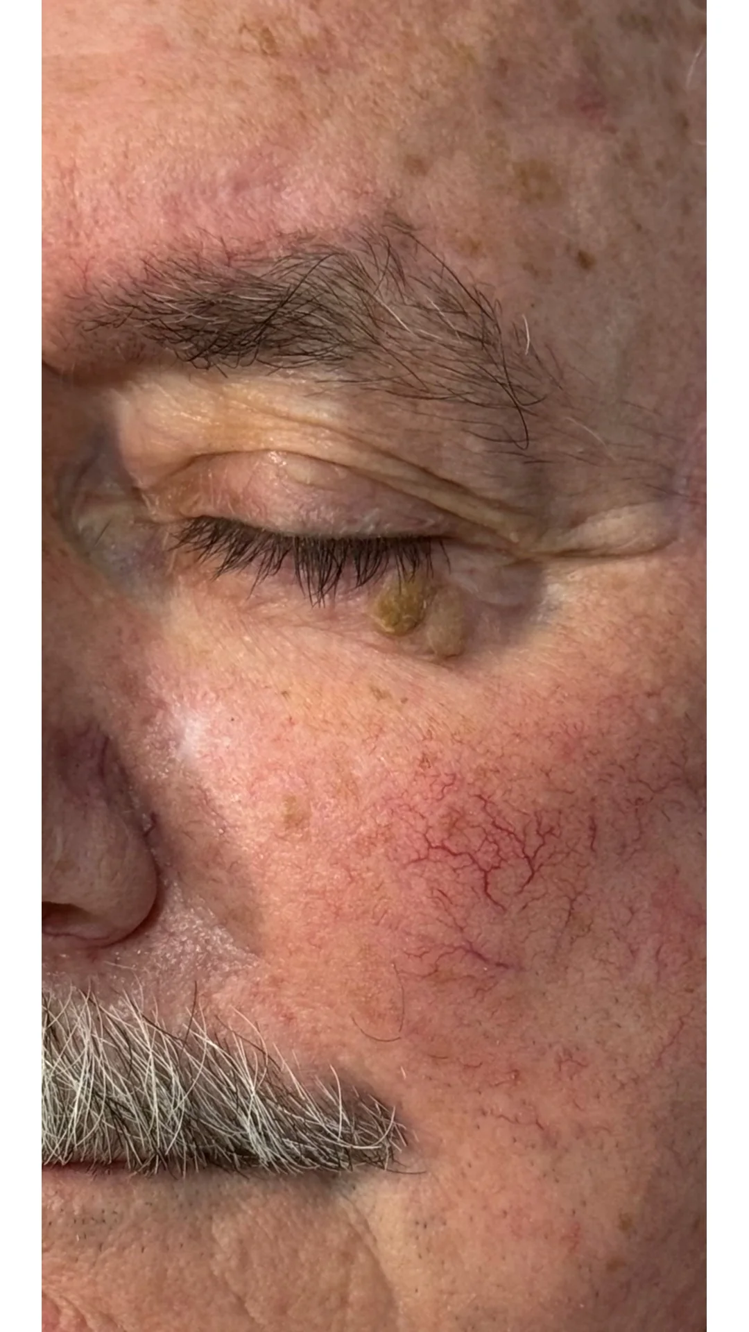 Lesions & Moles Removal before — Rejuvena Clinic Bedford