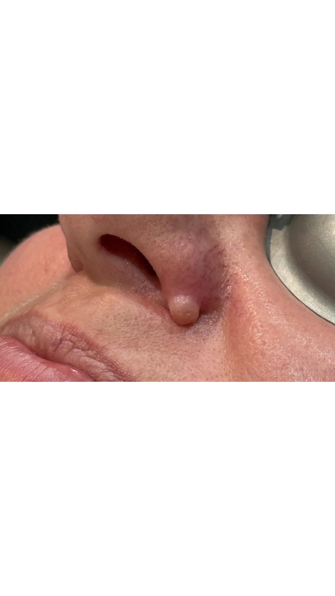 Lesions & Moles Removal before — Rejuvena Clinic Bedford