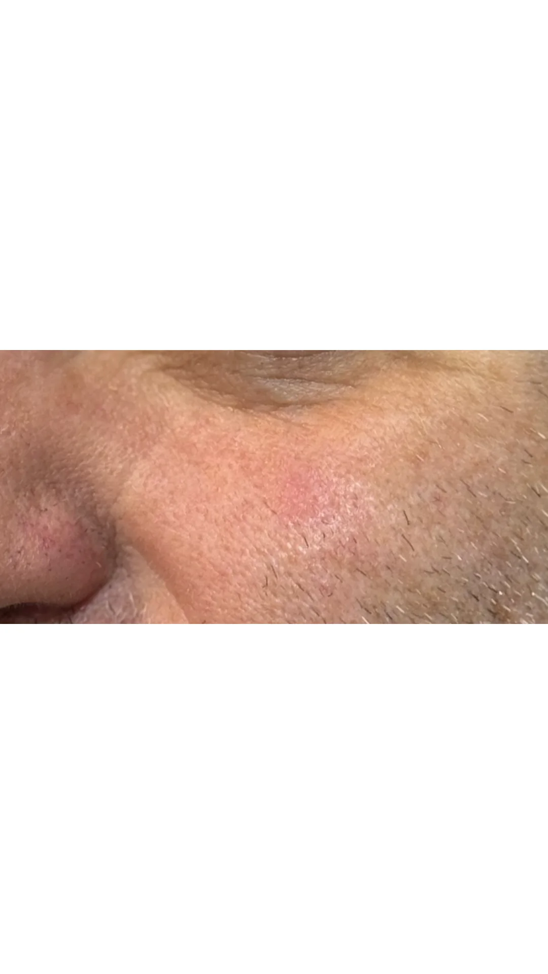 Lesions & Moles Removal after — Rejuvena Clinic Bedford