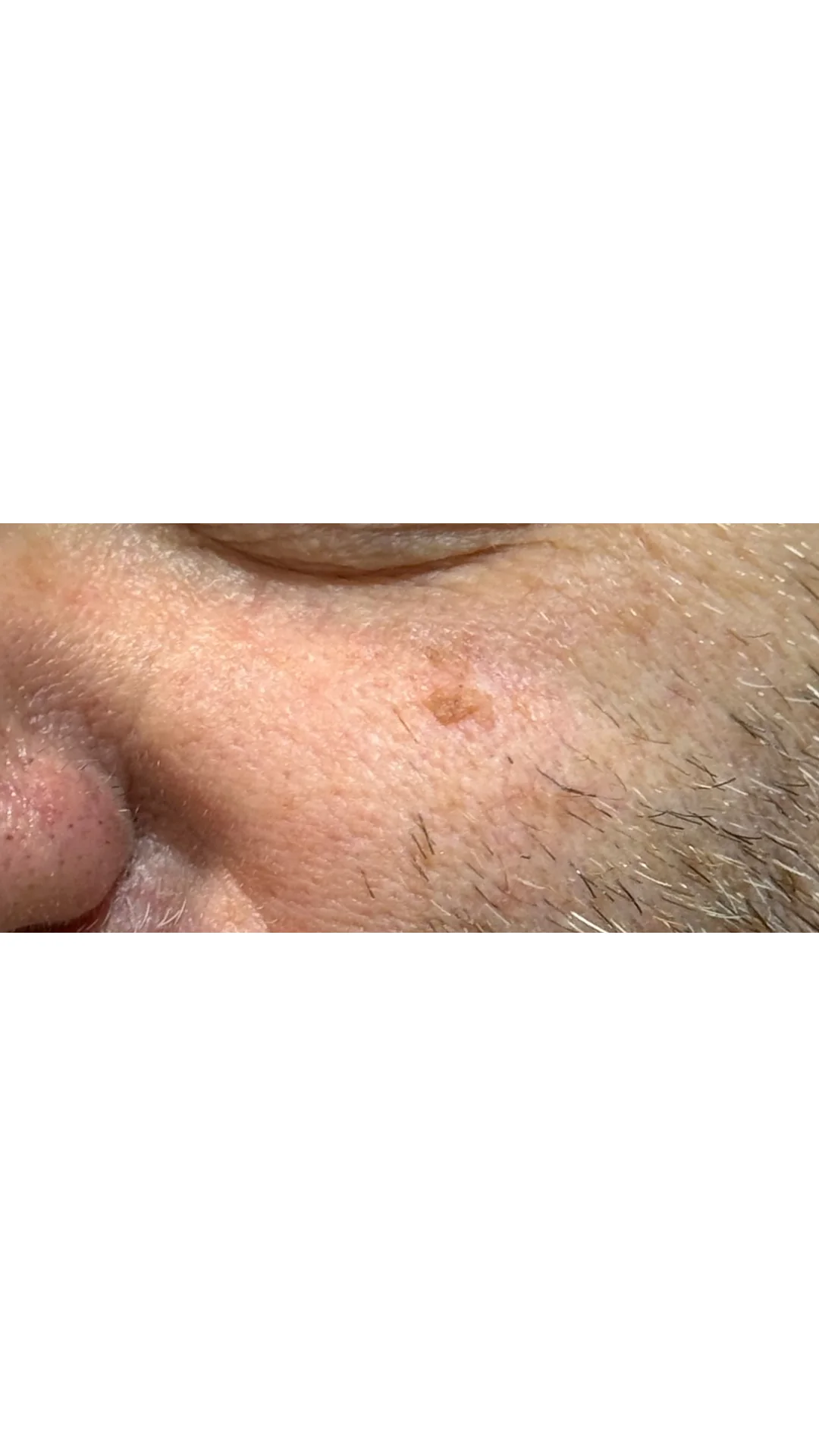 Lesions & Moles Removal before — Rejuvena Clinic Bedford