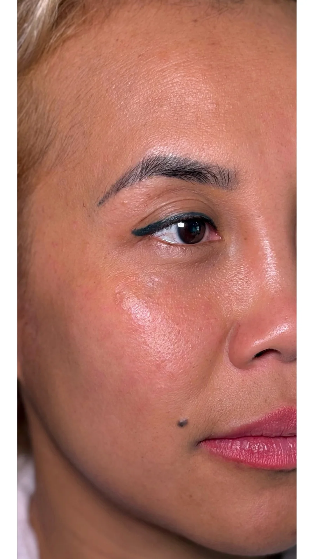 Lesions & Moles Removal after — Rejuvena Clinic Bedford