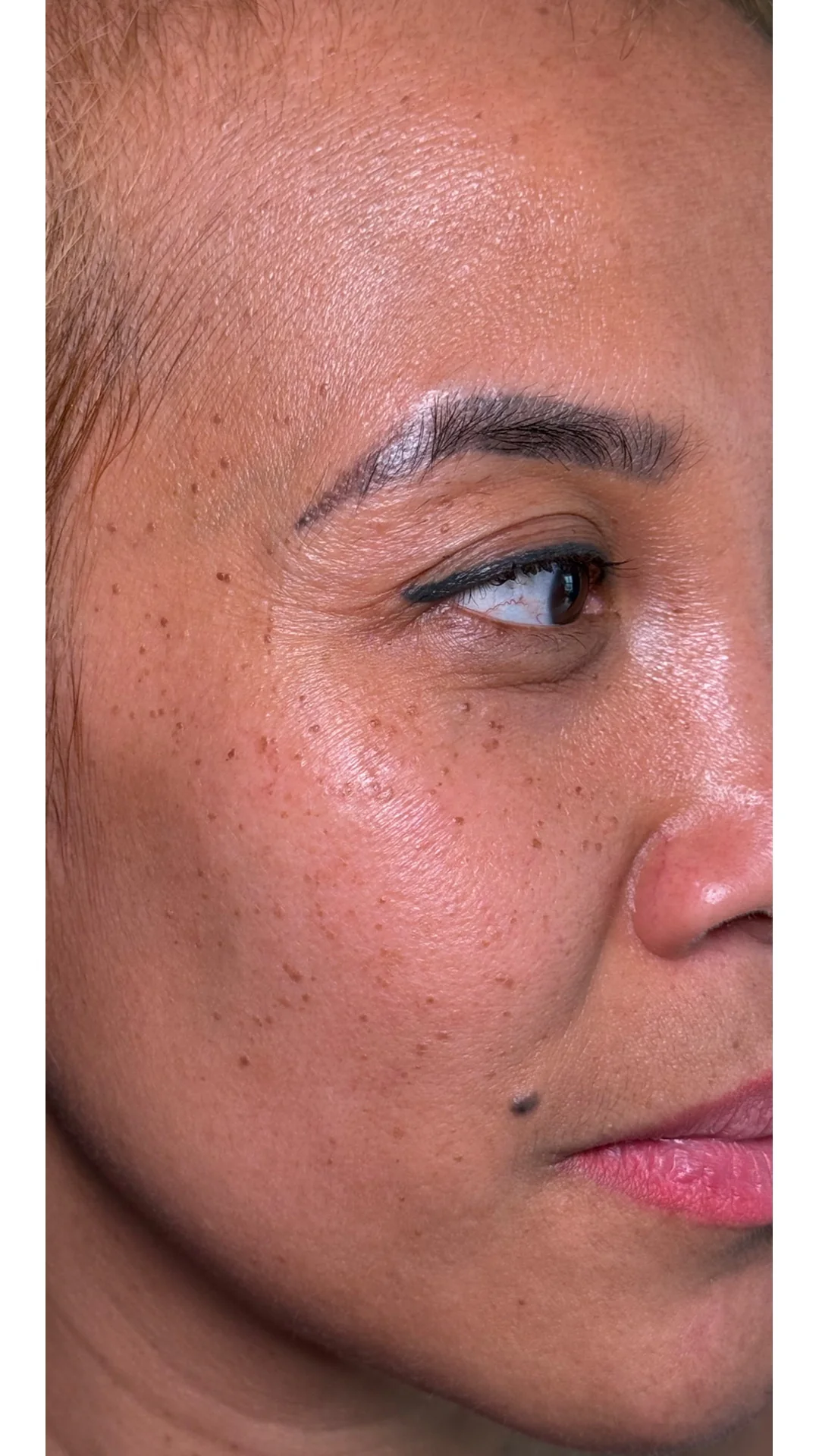 Lesions & Moles Removal before — Rejuvena Clinic Bedford