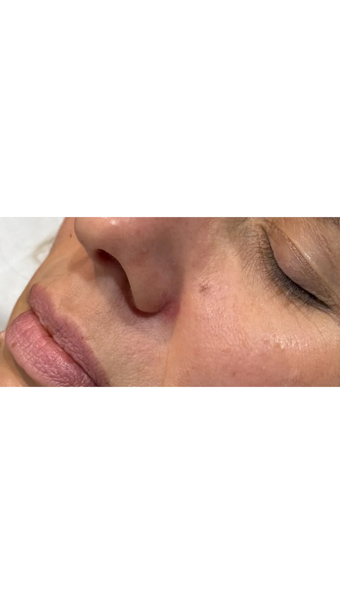 Lesions & Moles Removal after — Rejuvena Clinic Bedford