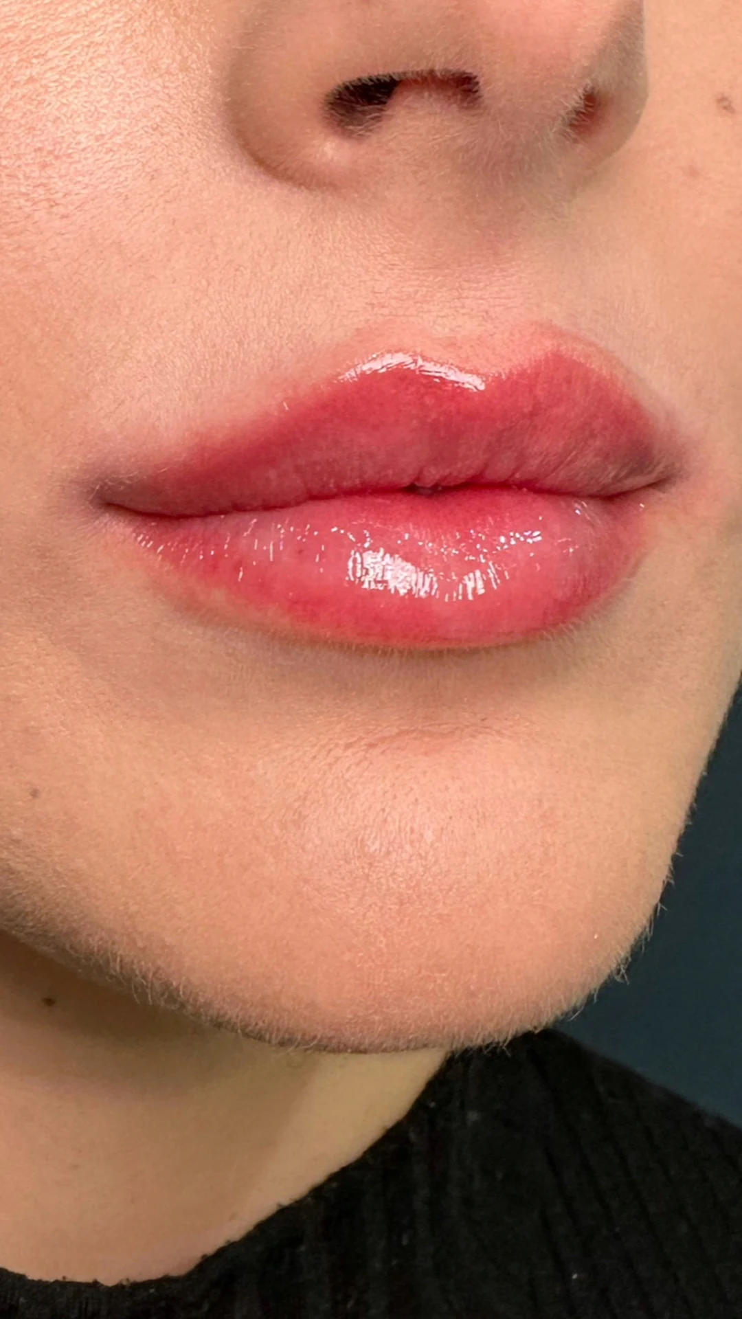 Lip Filler after — Rejuvena Clinic Bedford