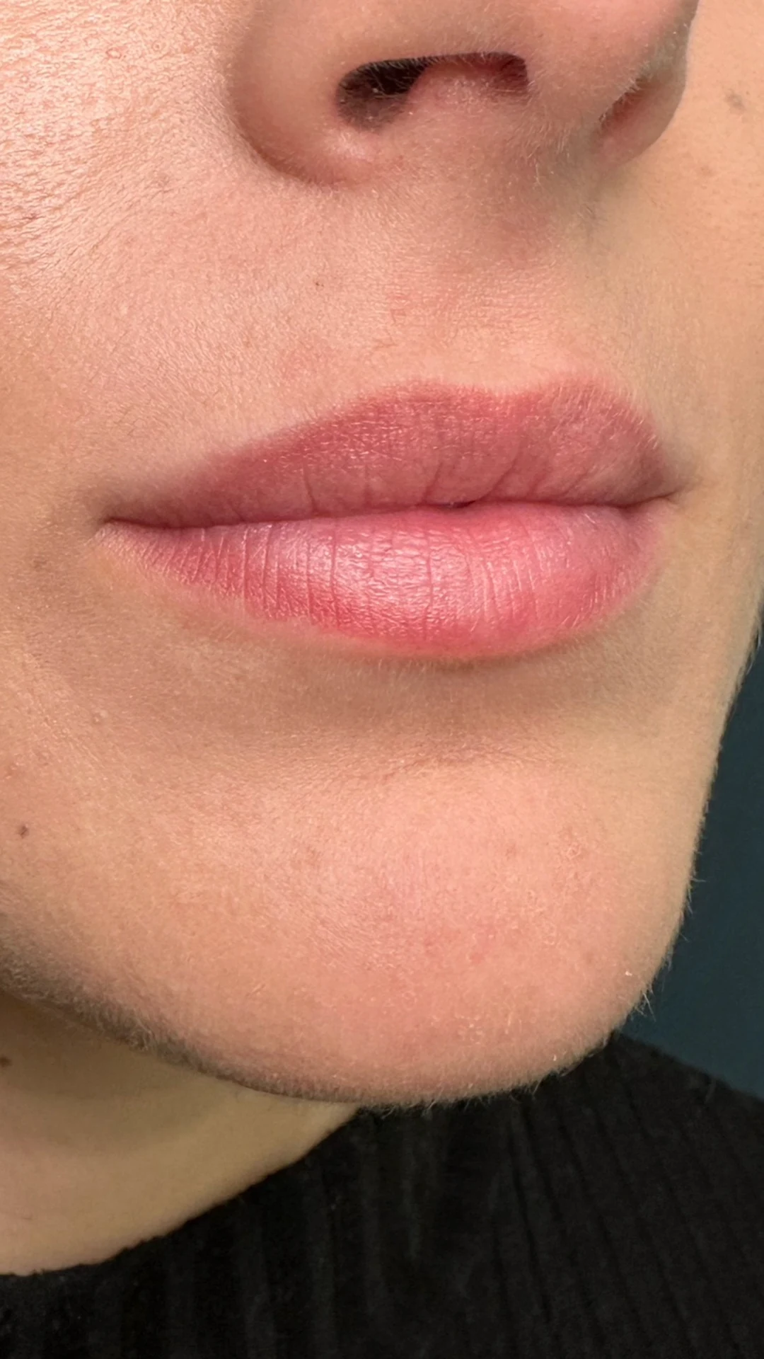 Lip Filler before — Rejuvena Clinic Bedford