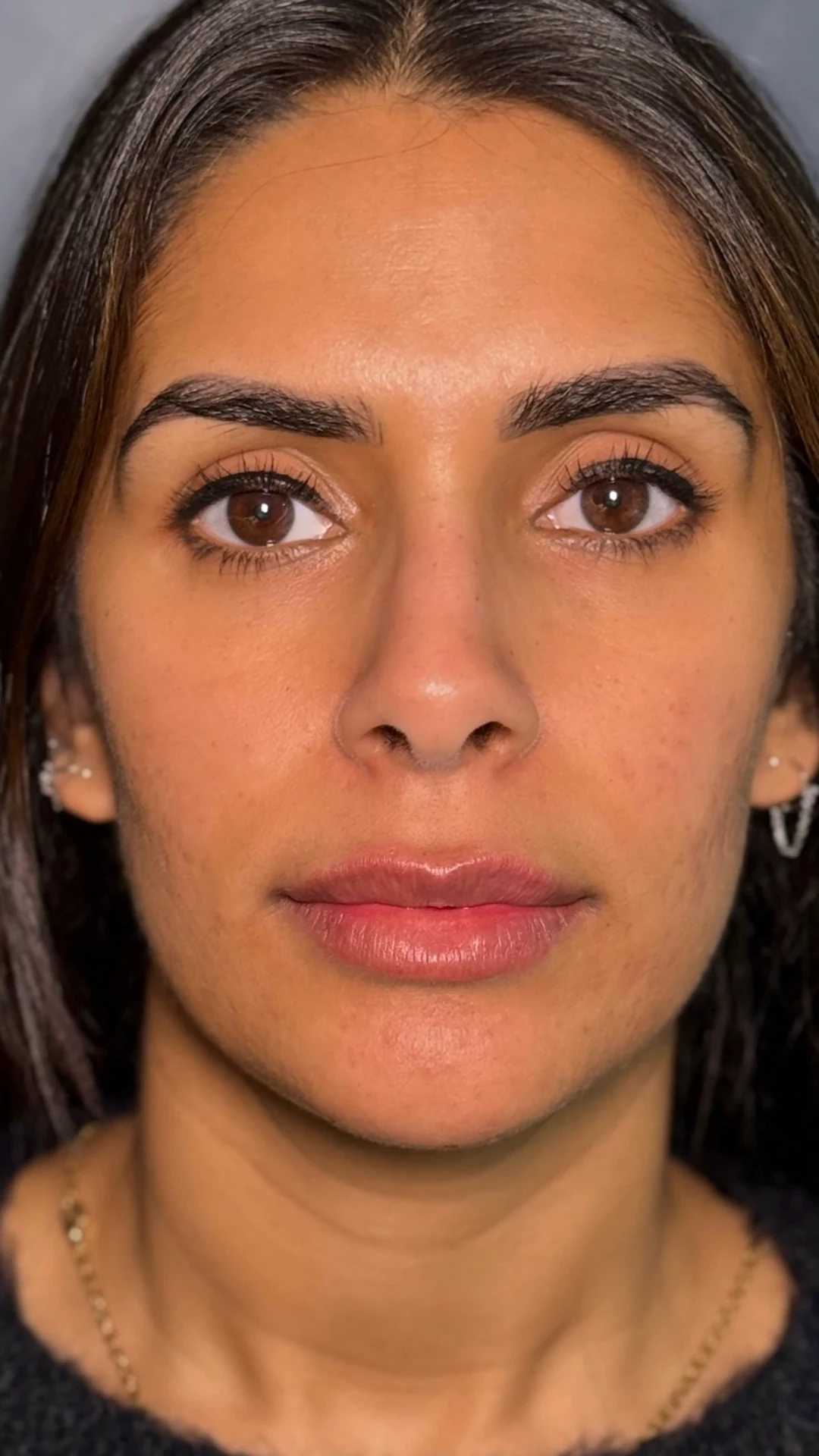 Lip Filler after — Rejuvena Clinic Bedford