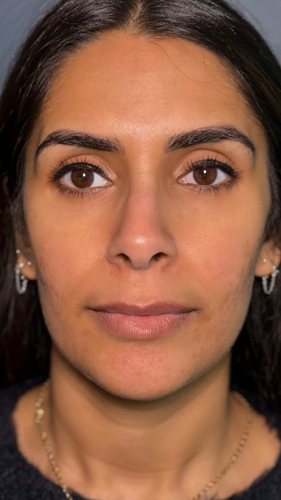 Lip Filler before — Rejuvena Clinic Bedford