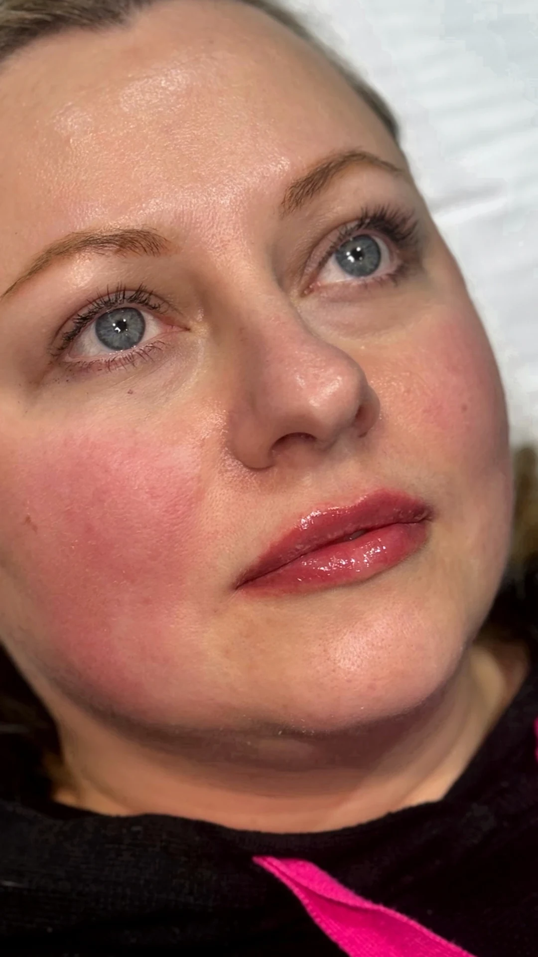 Lip Filler after — Rejuvena Clinic Bedford
