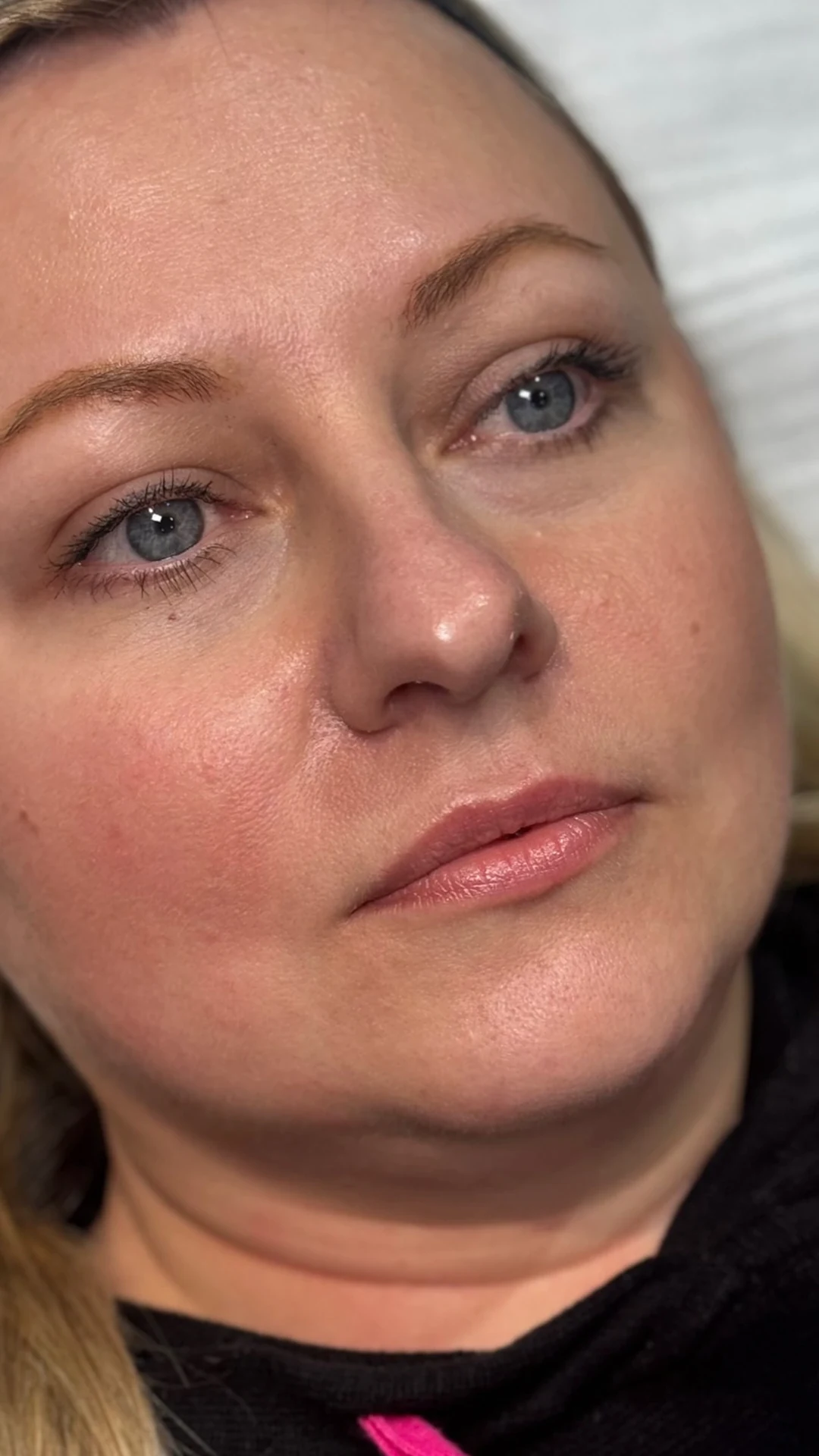 Lip Filler before — Rejuvena Clinic Bedford