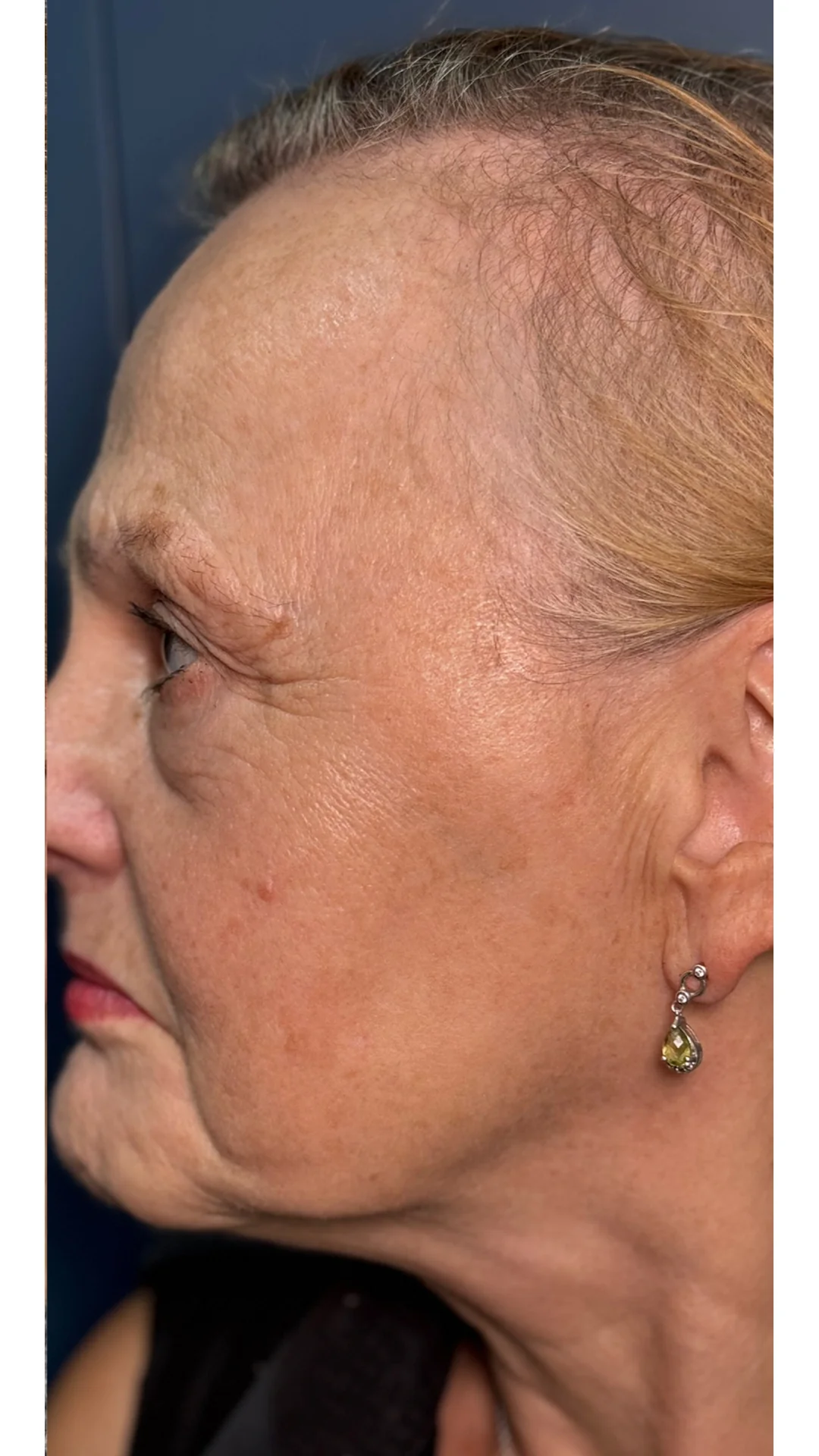 Lumecca after — Rejuvena Clinic Bedford