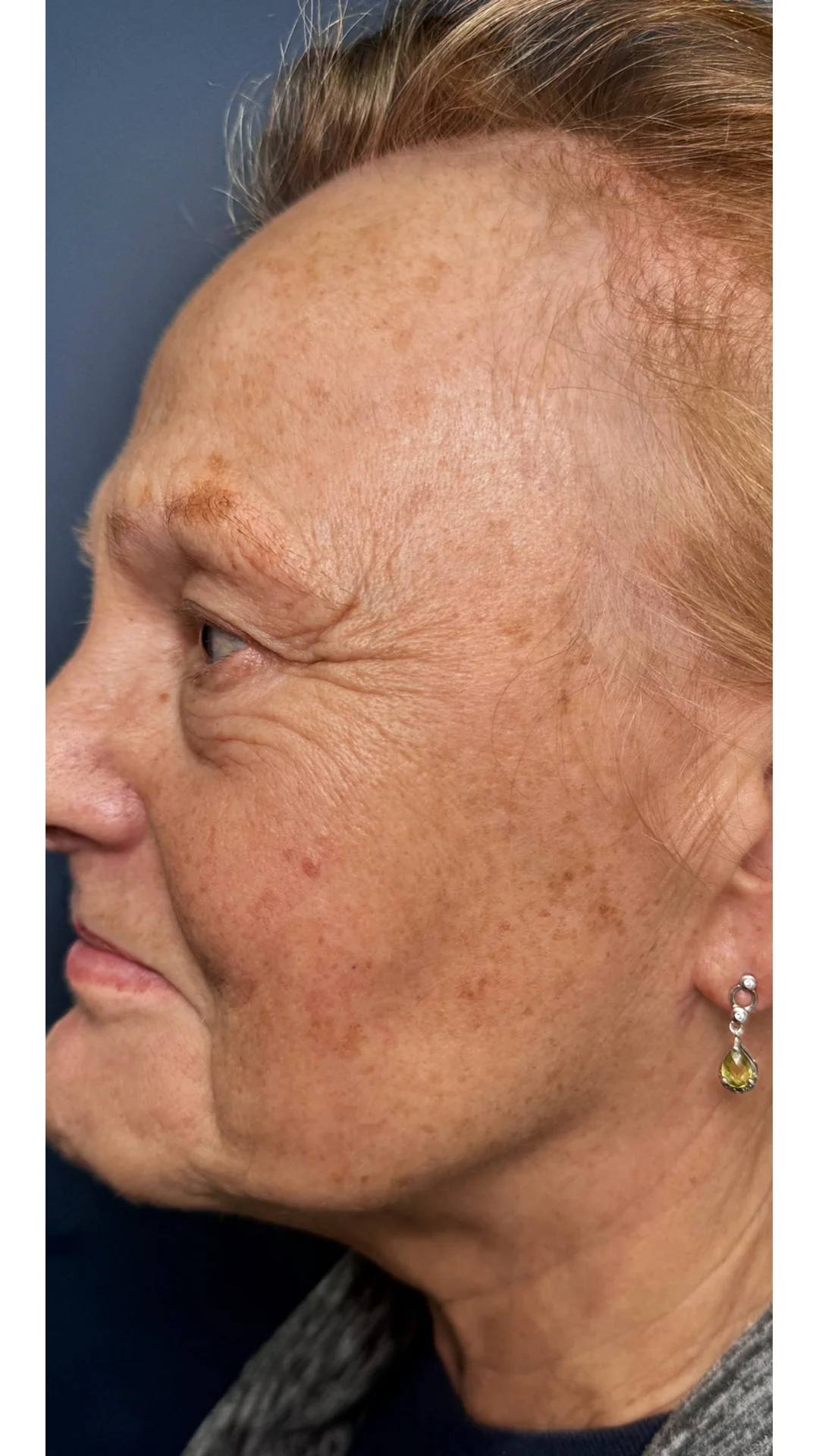 Lumecca before — Rejuvena Clinic Bedford