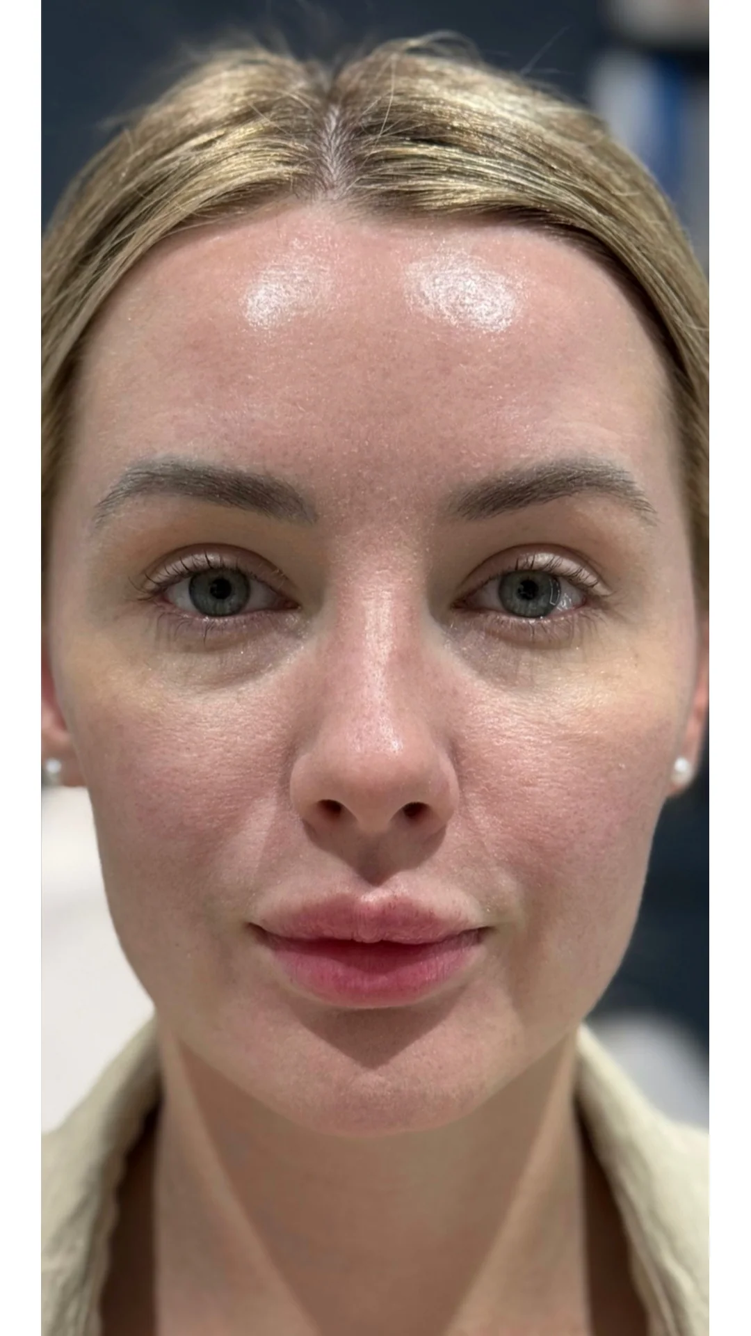 Lumecca after — Rejuvena Clinic Bedford