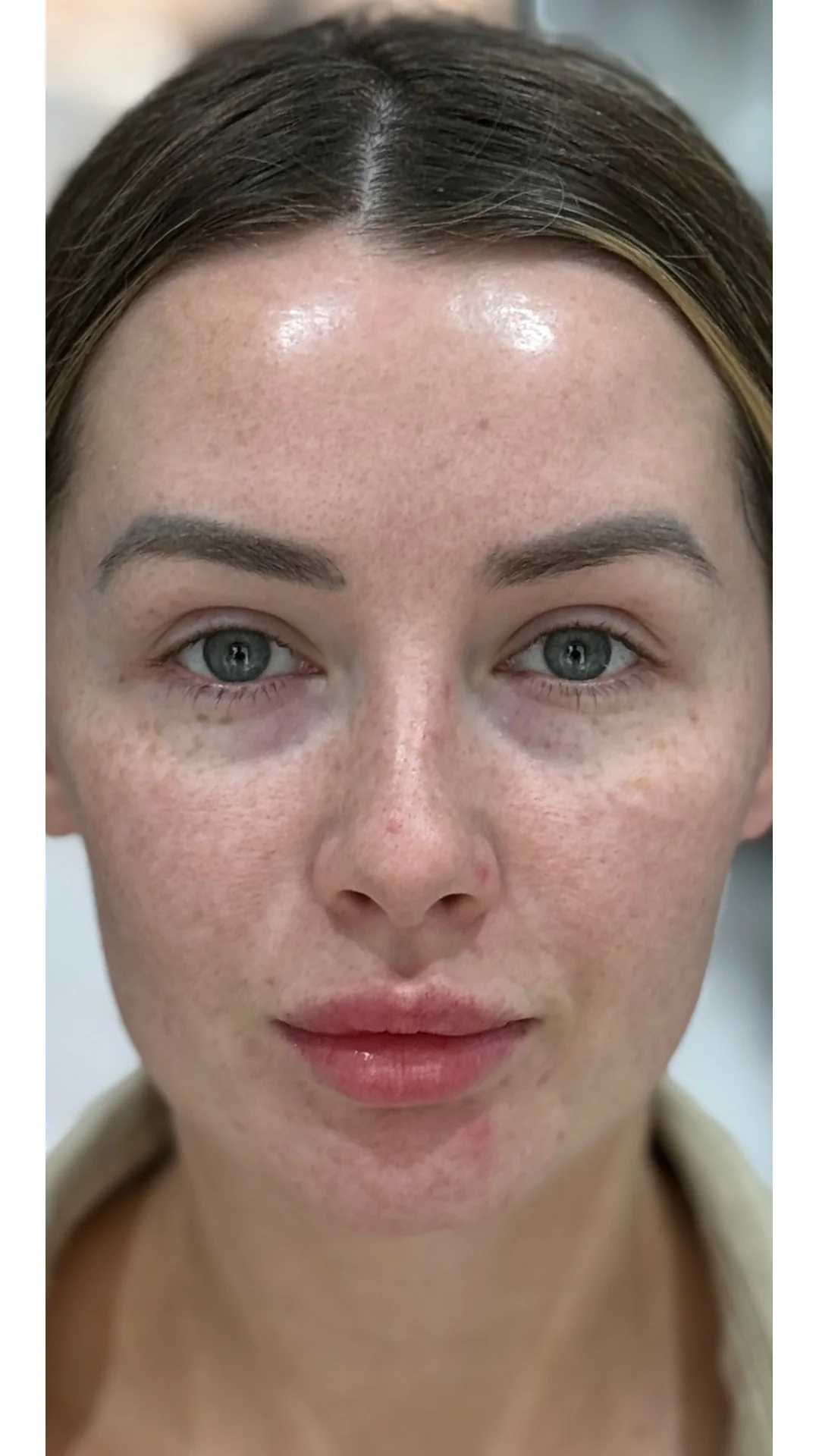 Lumecca before — Rejuvena Clinic Bedford