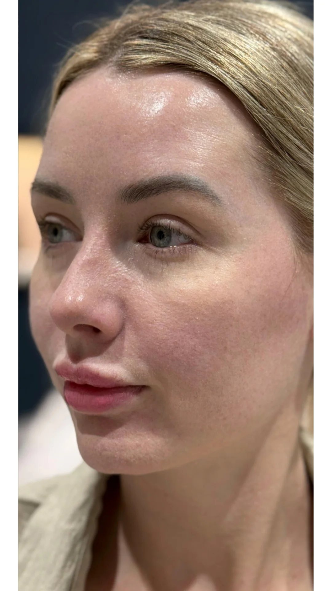 Lumecca after — Rejuvena Clinic Bedford