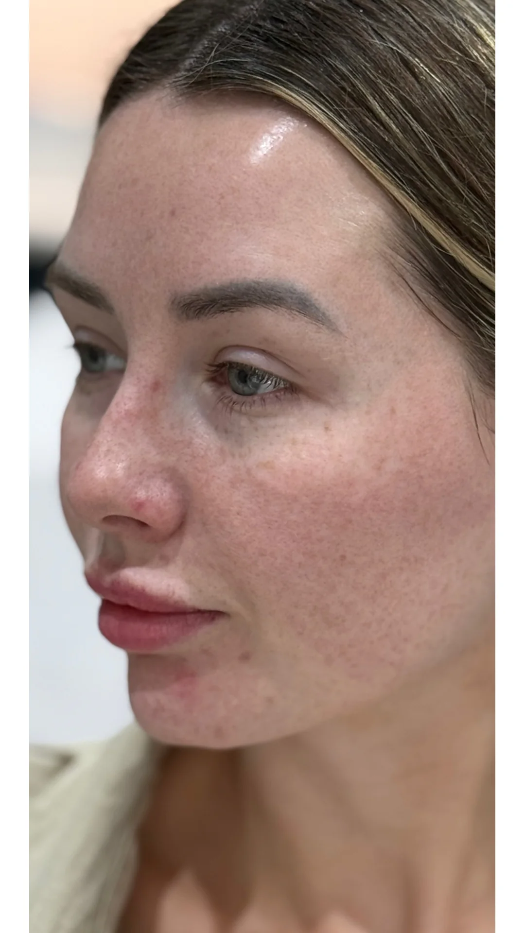 Lumecca before — Rejuvena Clinic Bedford