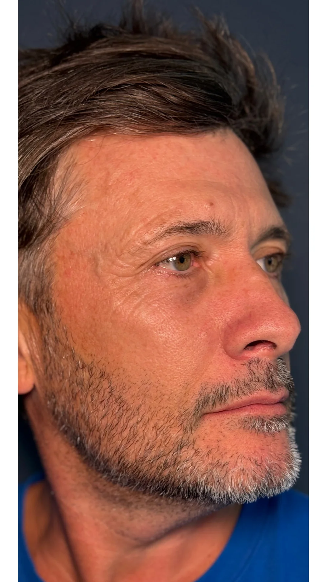 Lumecca after — Rejuvena Clinic Bedford