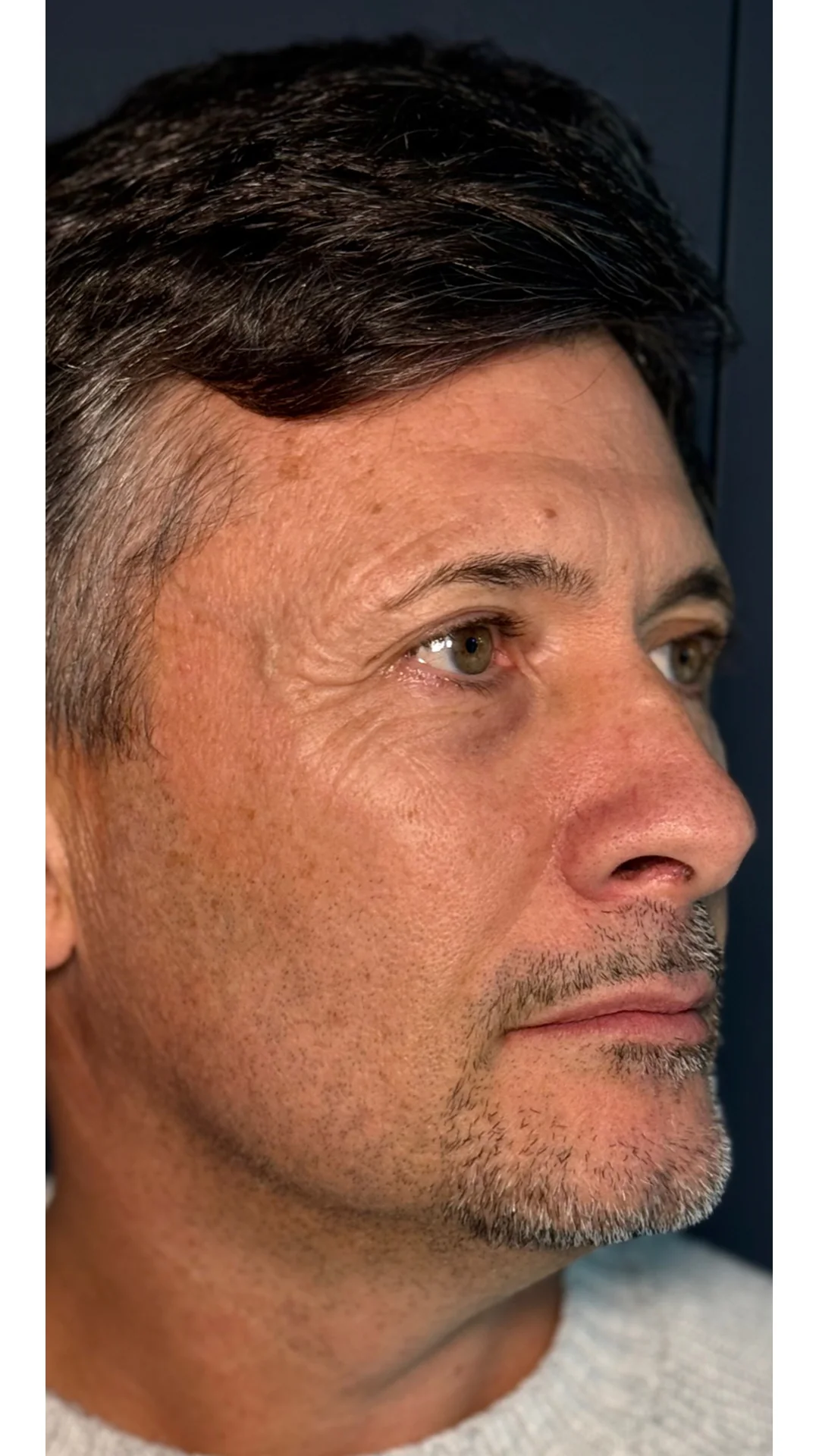 Lumecca before — Rejuvena Clinic Bedford