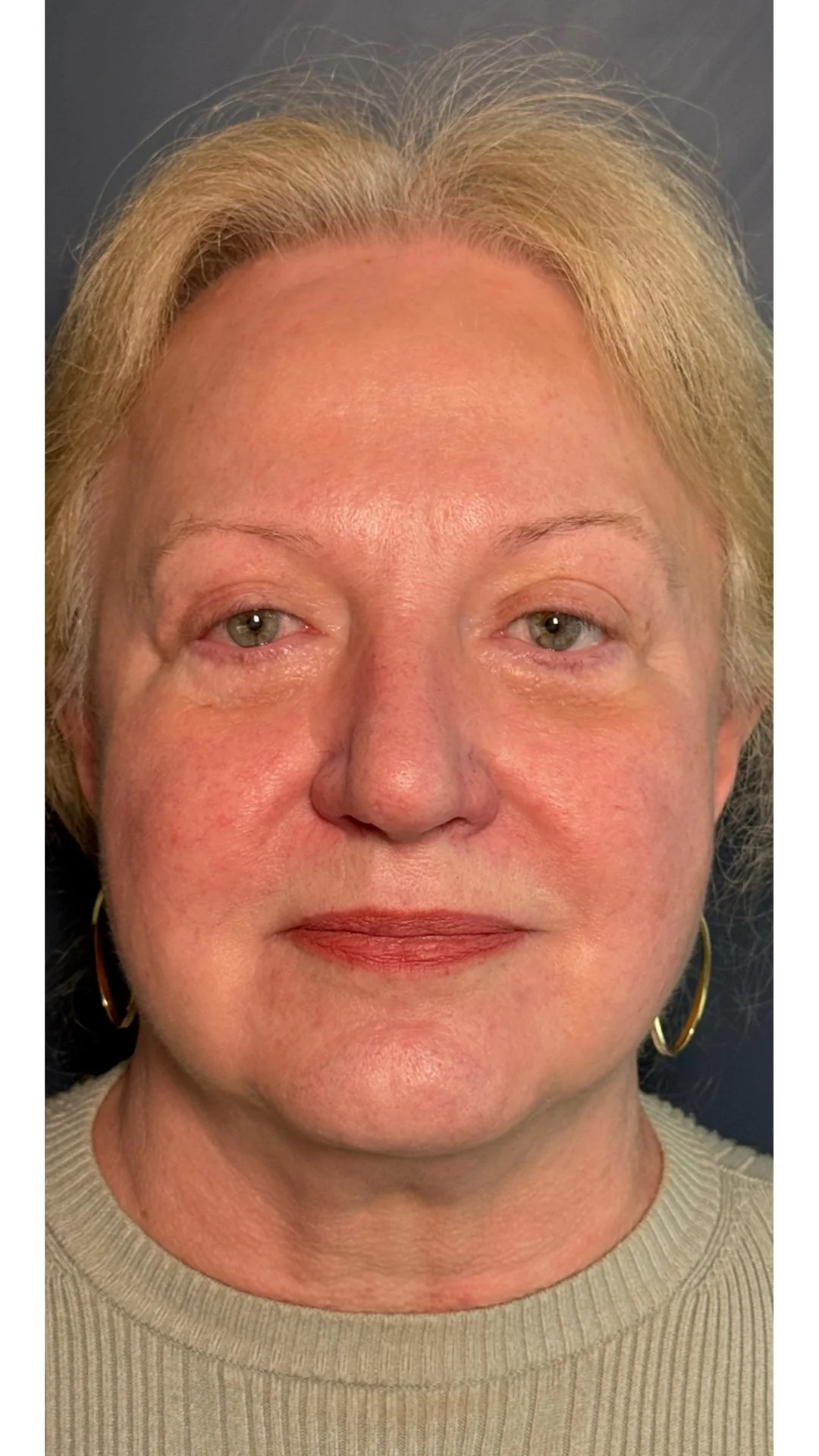 Lumecca after — Rejuvena Clinic Bedford