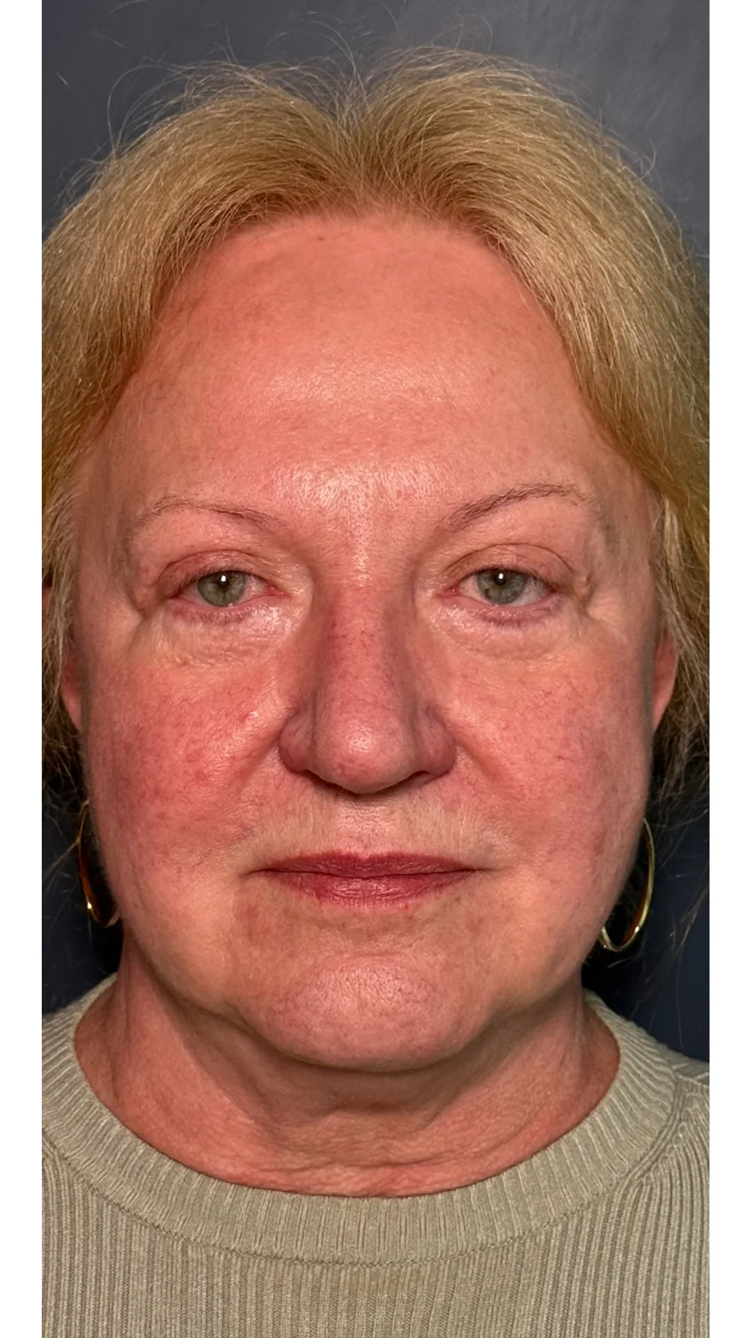 Lumecca before — Rejuvena Clinic Bedford
