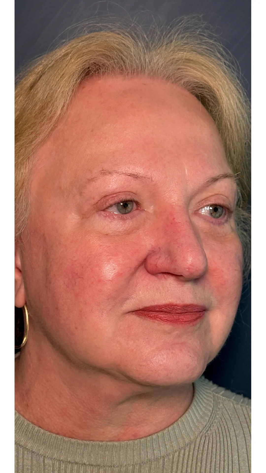 Lumecca after — Rejuvena Clinic Bedford