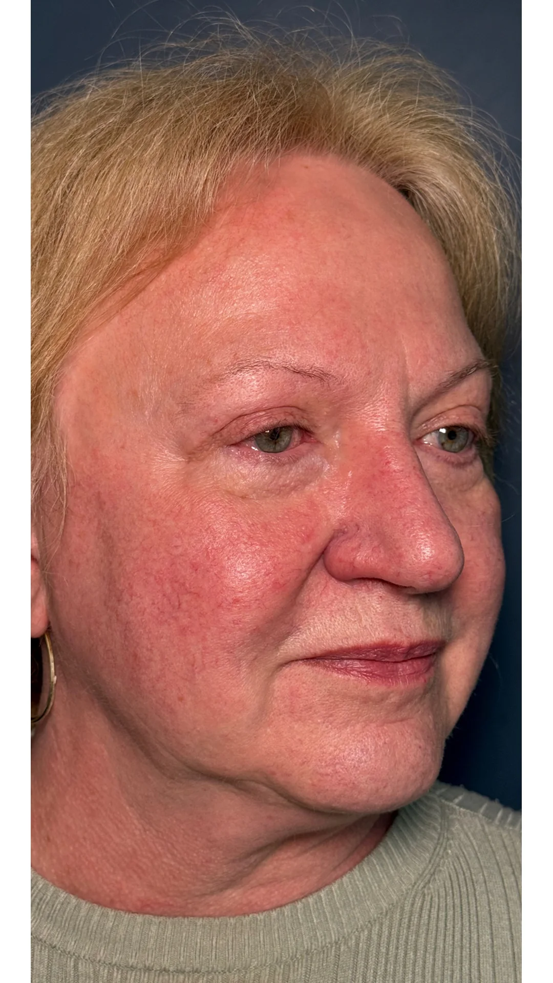 Lumecca before — Rejuvena Clinic Bedford