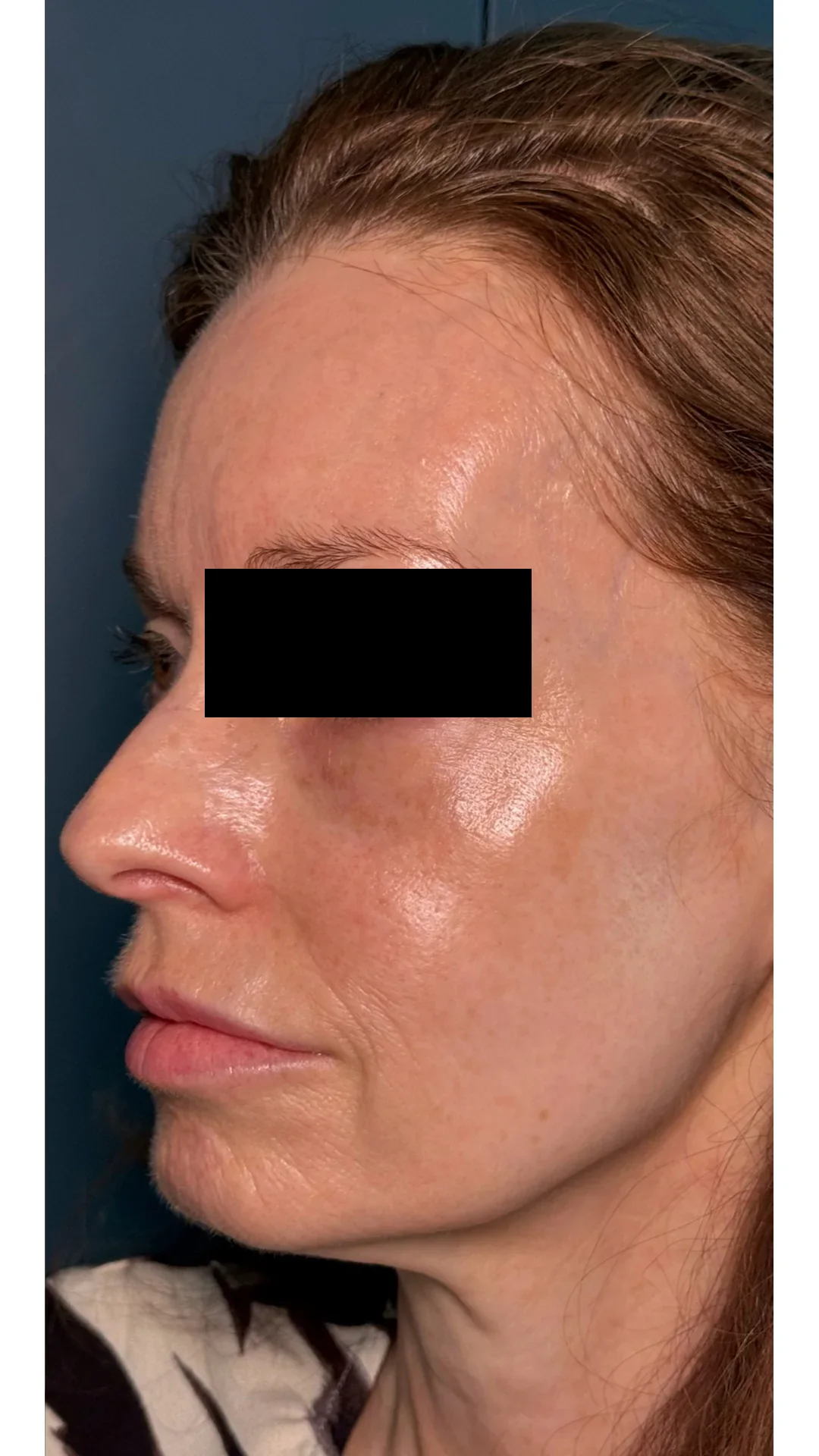 Lumecca after — Rejuvena Clinic Bedford