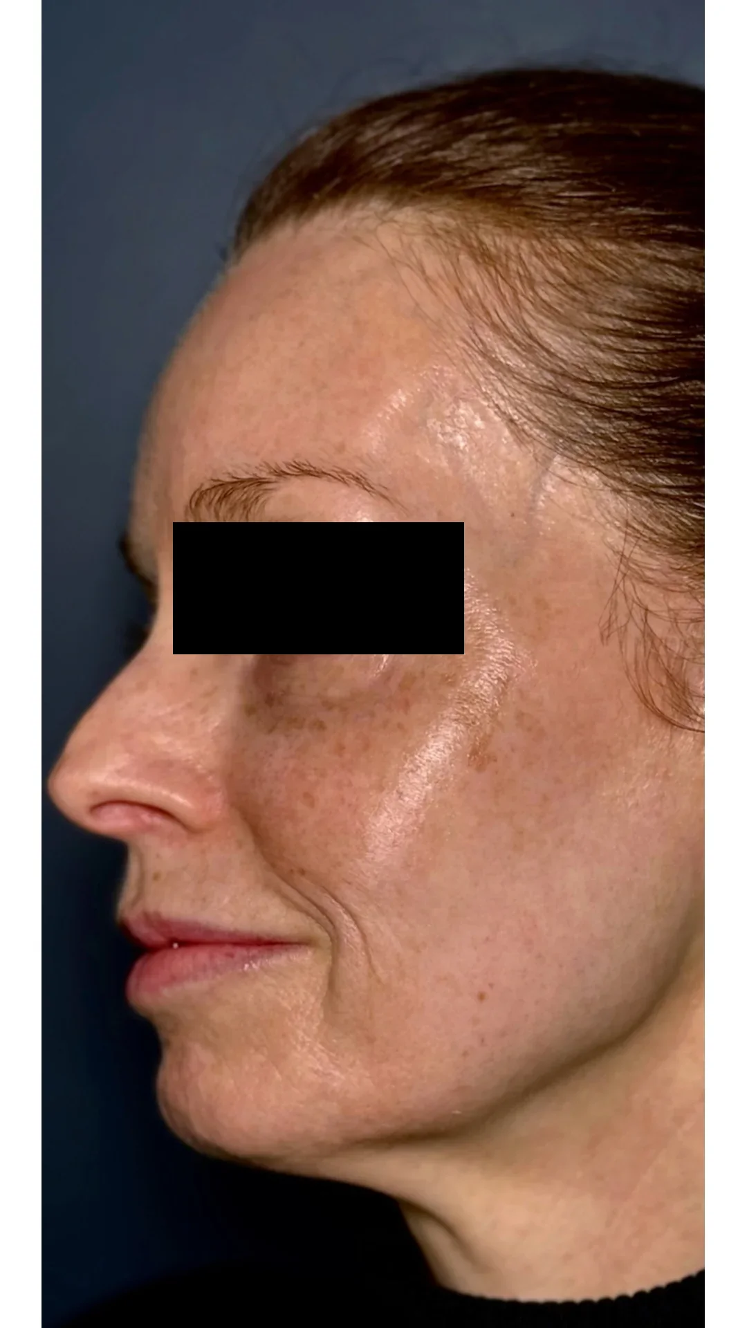 Lumecca before — Rejuvena Clinic Bedford