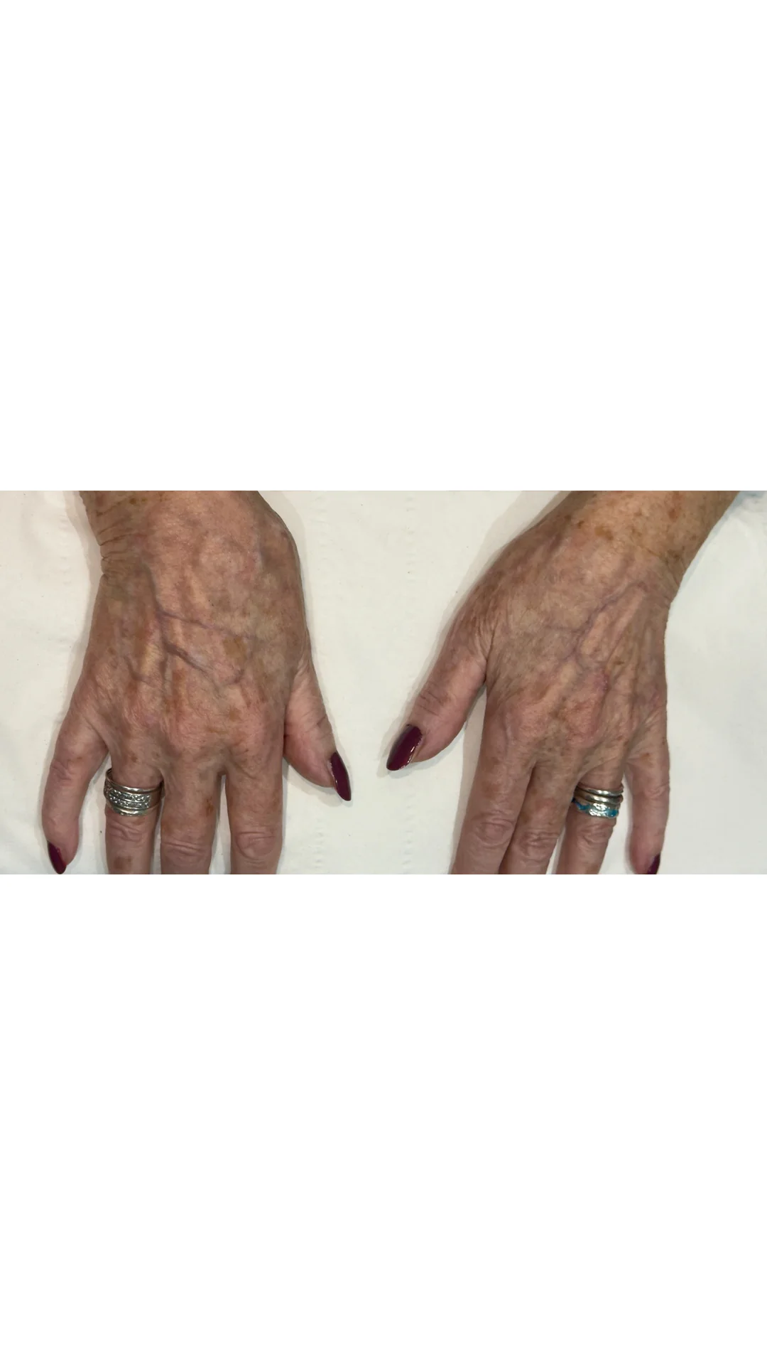 Lumecca after — Rejuvena Clinic Bedford