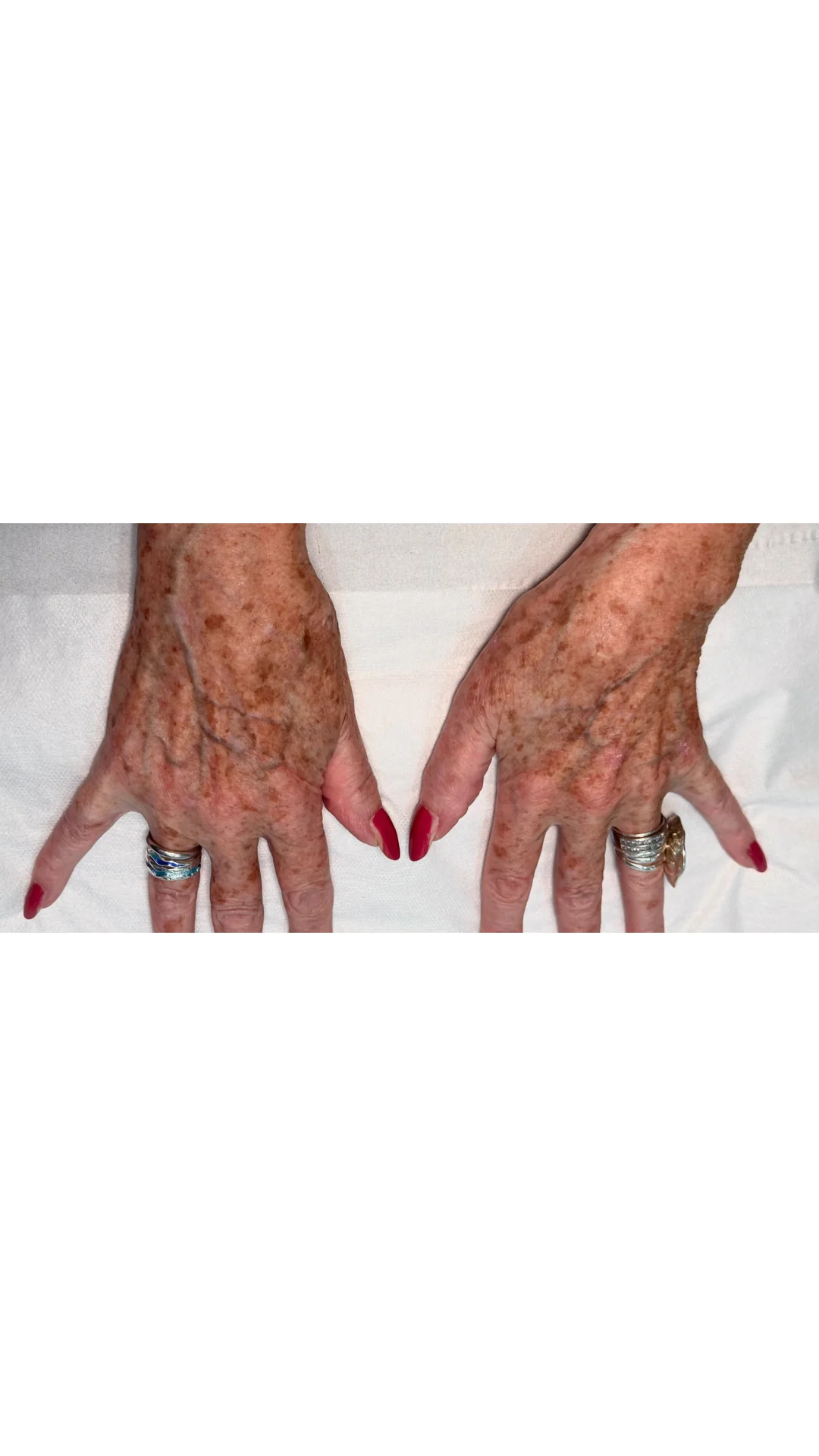 Lumecca before — Rejuvena Clinic Bedford