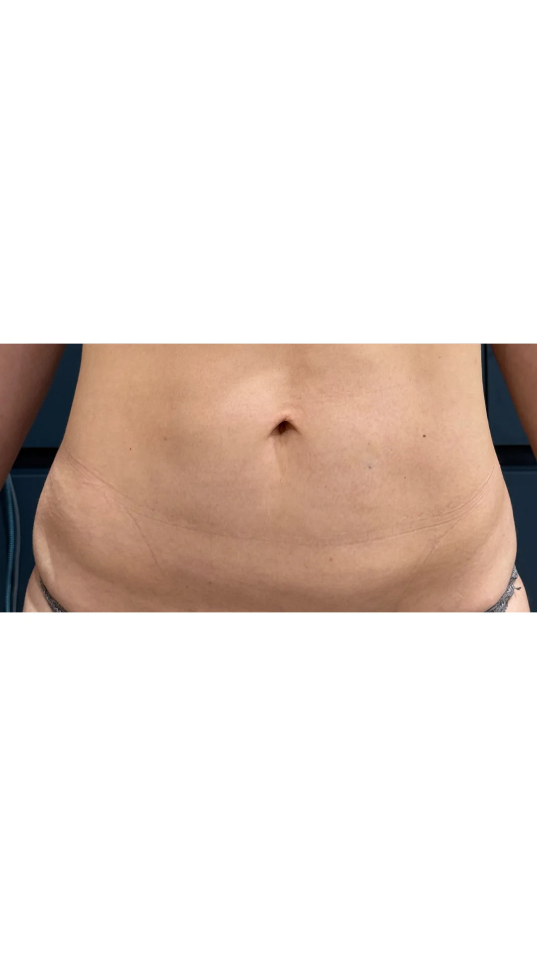 Morpheus 8 Burst after — Rejuvena Clinic Bedford