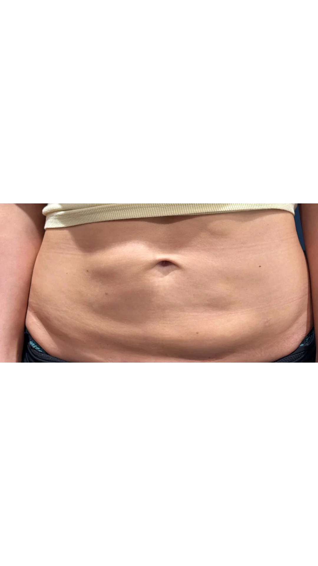 Morpheus 8 Burst before — Rejuvena Clinic Bedford