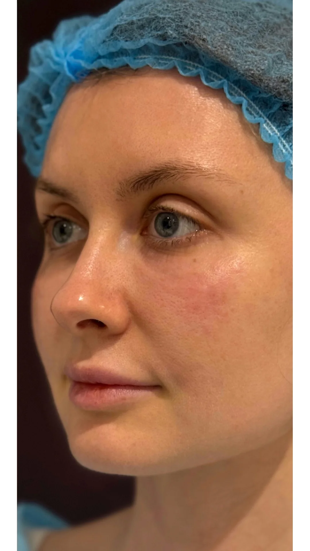 Nanofat Transfer after — Rejuvena Clinic Bedford