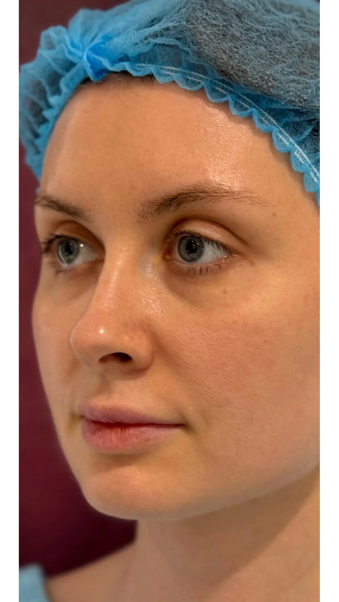 Nanofat Transfer before — Rejuvena Clinic Bedford