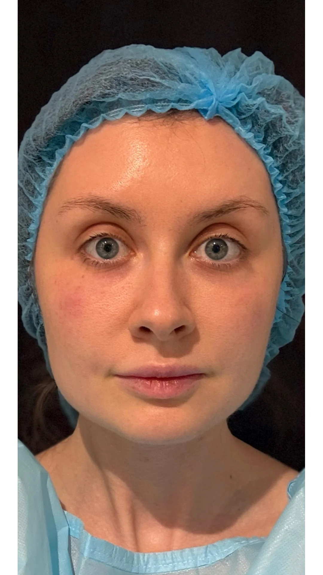 Nanofat Transfer after — Rejuvena Clinic Bedford