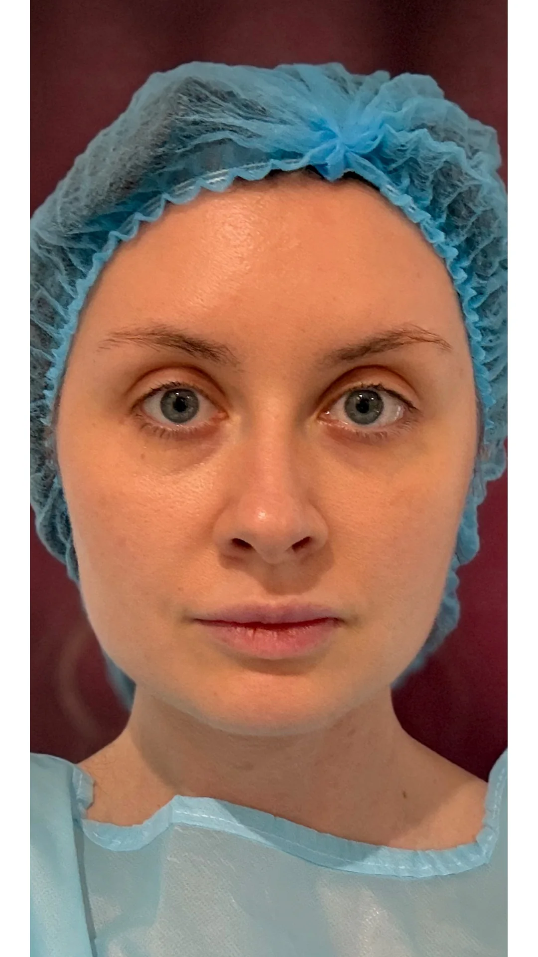 Nanofat Transfer before — Rejuvena Clinic Bedford