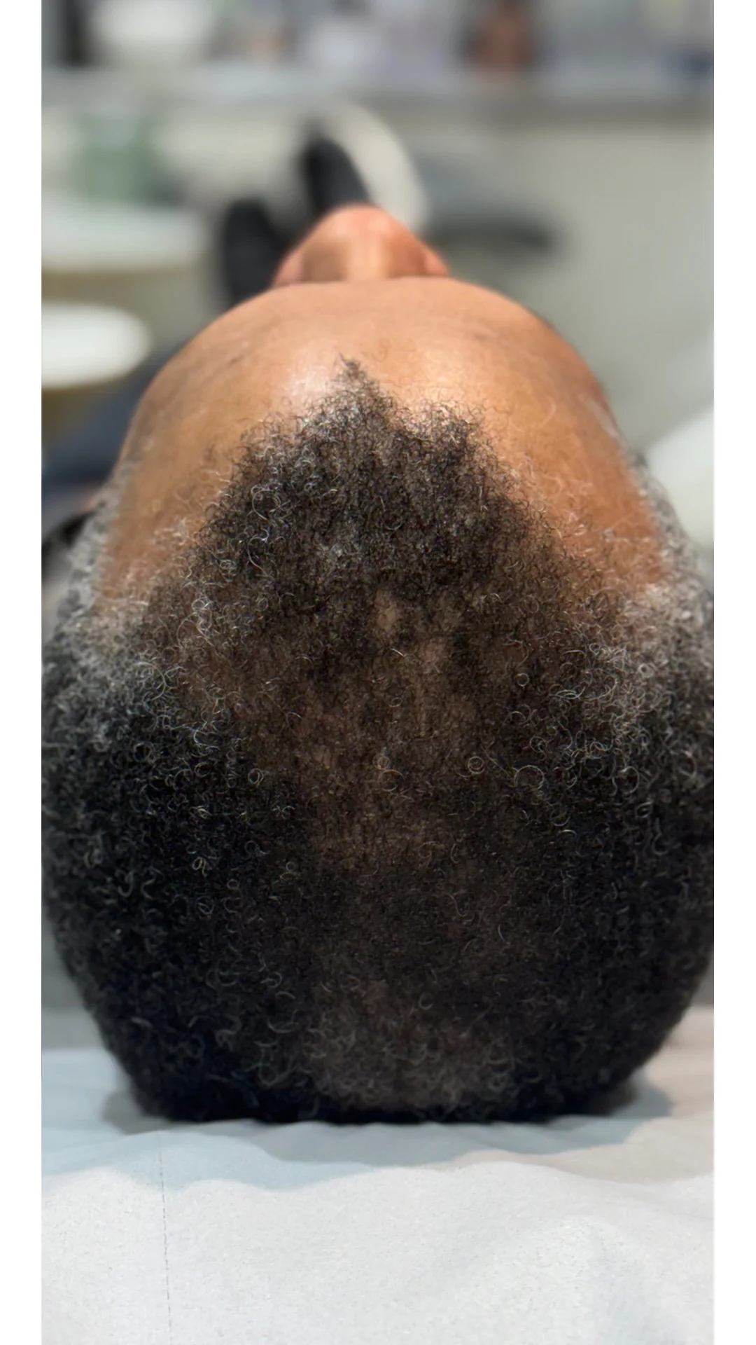 PRP Hair Loss after — Rejuvena Clinic Bedford
